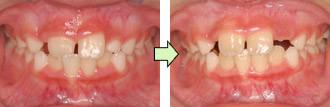 ムーシールドによる反対咬合（うけ口）の治療例2